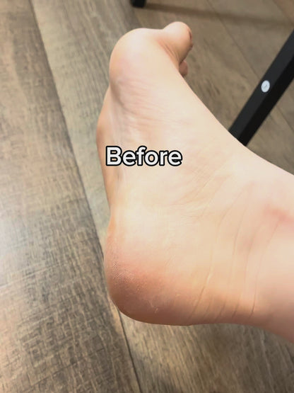 Clee™ Electric Callous Remover